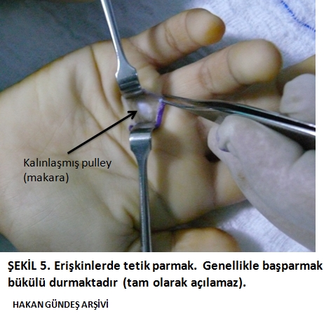 Tetik Parmak | Prof. Dr. Hakan Gündeş | El Cerrahisi Uzmanı