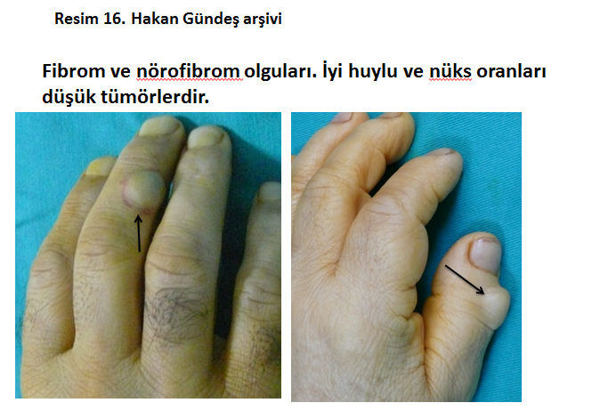 nurofibrom