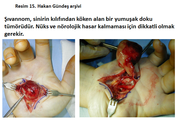 sinir-dokusu