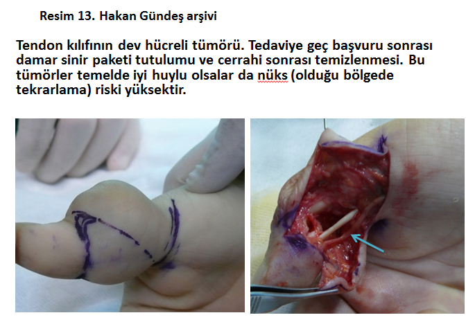 tendon-kilif