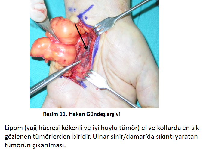 yag-hucresi-tumor
